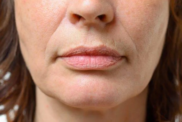 Jowls