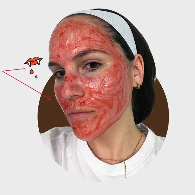 Vampyre Facial