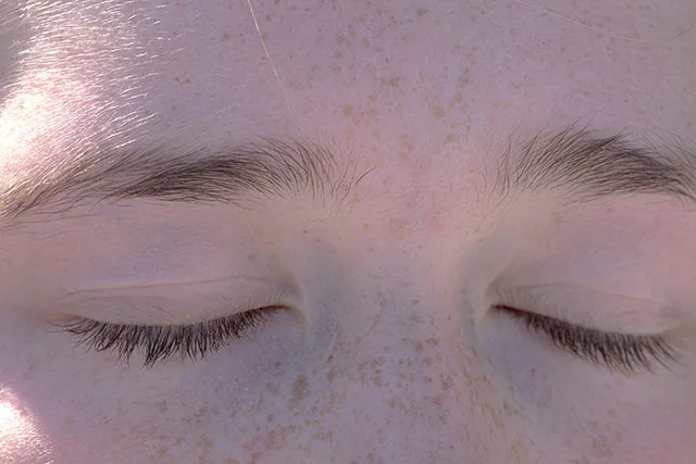 Hyperpigmentation